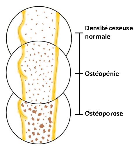 La différence entre la densité osseuse normale, l'ostéopénie et l'ostéoporose