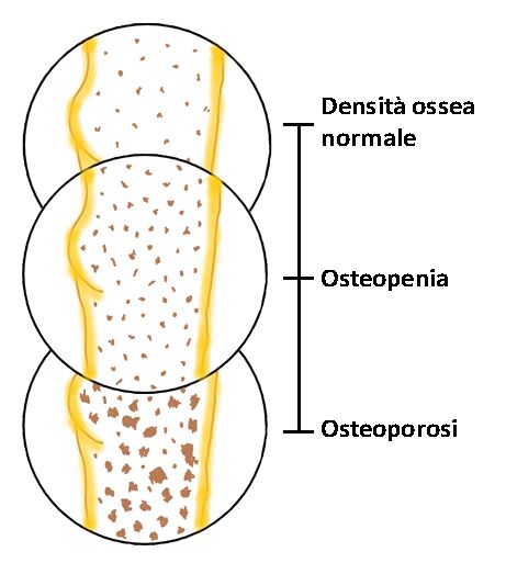 La differenza tra la densità ossea normale, l'osteopenia e l'osteoporosi