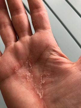 Psoriasis alla mano