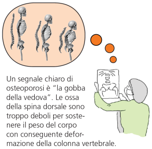 Un chiaro segno di un'osteoporosi emergente è la cosiddetta gobba della vedova.